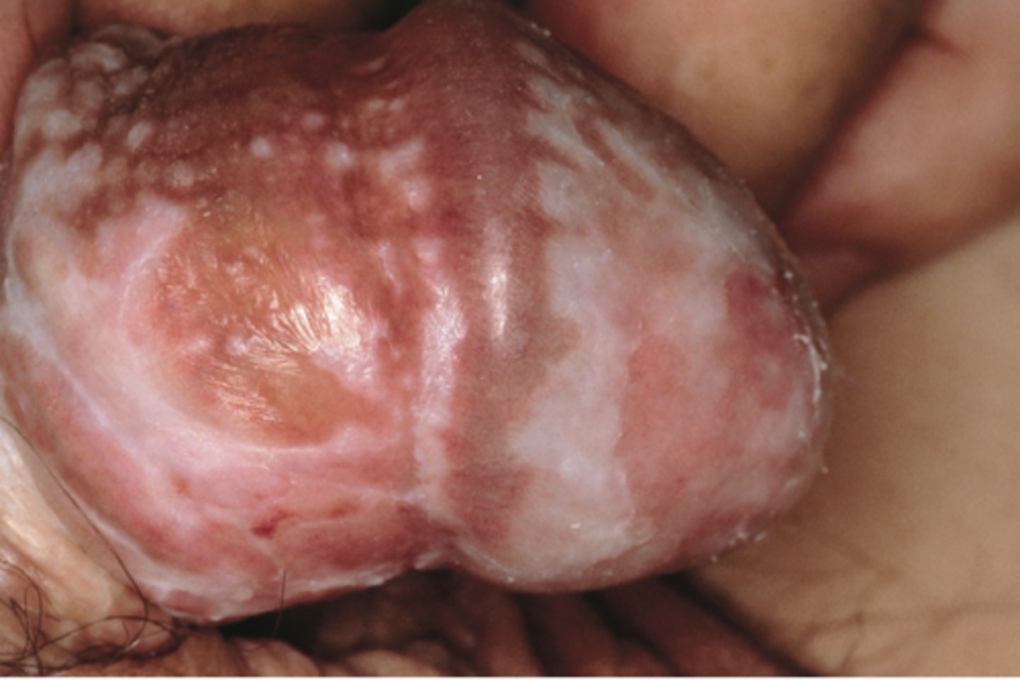 <p>Chronic, progressive, inflammatory condition of the skin with characteristic white plaques </p><p>- Often affects the genital regions </p><p>Penile Lichen sclerosus:</p><p>- May cause scarring of the glans and prepuce </p><p>- Is a precancerous lesion &amp; therefore increase risk of cancer</p>