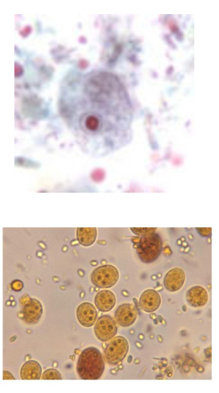 <p>Occurence - occurs in 21% of worldwide population</p><p>Non pathogenic. </p><p>Morphology - Trophozoites 5-10 microns. Nucleus has a large &amp; blot like karyosome. Little to no peripheral chromatin. Cysts are sub-oval with 4-6 by 6-10 microns.</p>
