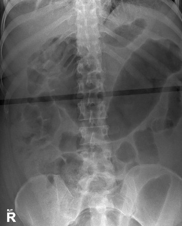 <p>Identify this pathology and state its symptoms</p>