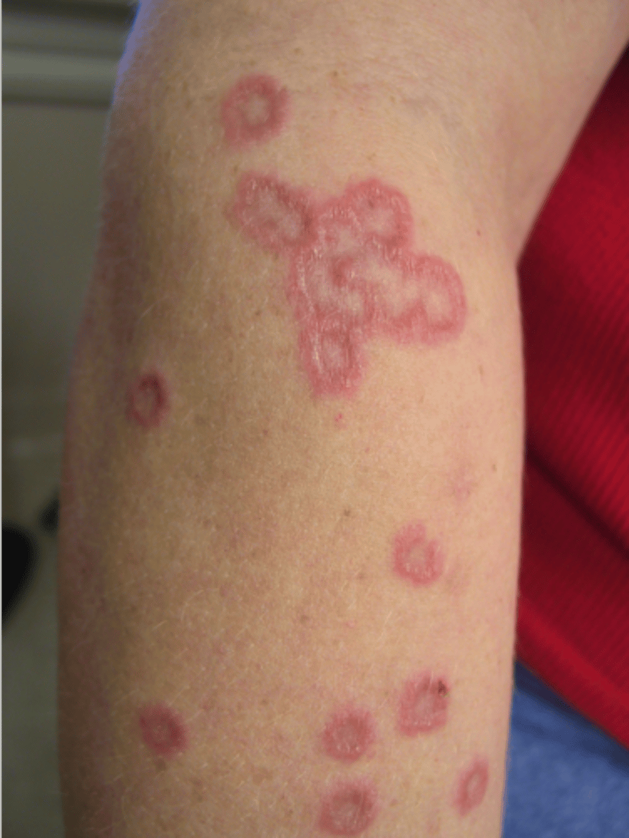 <p>Ring/arc-shaped lesions that are raised &amp; sharply-defined; may develop secondary to DM; easily mistaken for tinea</p>