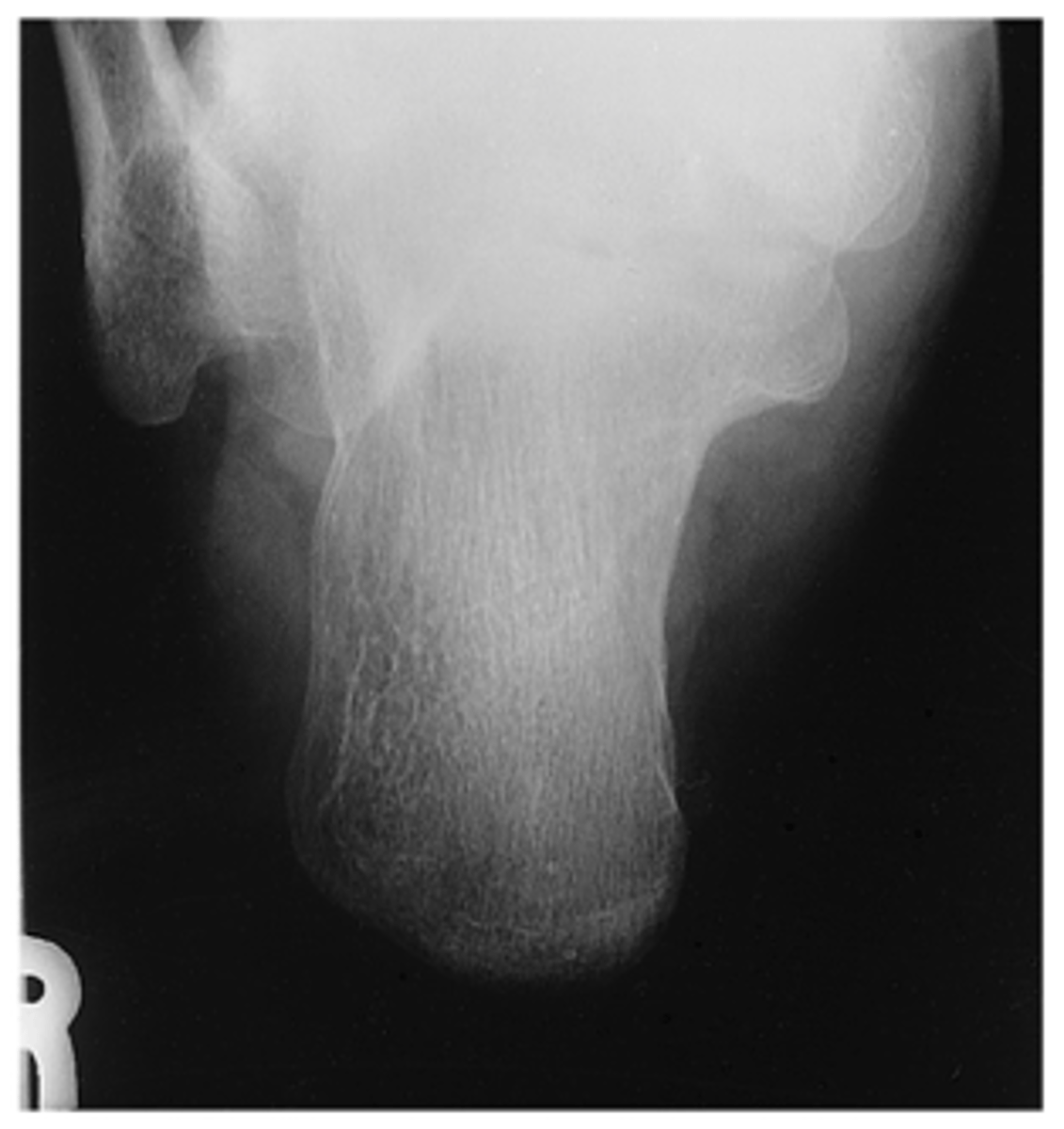 <p>- CR 40° to cephalad</p><p>- CR to base of third MT to emerge posterior to malleoli</p><p>- Entire calcaneus visualized</p><p>- No rotation</p><p>- Optimal exposure factors</p>
