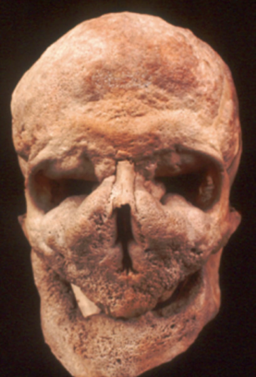 <p>- Heavy brow</p><p>- Upper skull</p><p>- Upper midface in nose region</p><p>- Enlarged mandible</p>