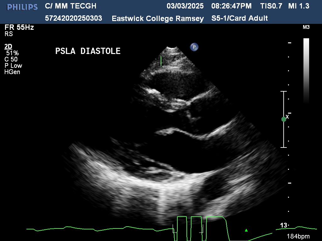 <p>PSLA DIASTOLE </p>