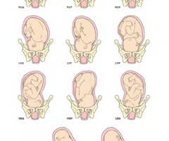 <p><span><strong>relationship of the presenting part to the pelvis</strong><br>*1st letter = maternal body (R or L)</span></p><p><span>*2nd letter = presenting part (O = occiput, S = sacrum, A = acromium/shoulder, B = brow)</span></p><p><span>*3rd letter = position of the presenting part (A = anterior, P = posterior, T = transverse)</span></p>