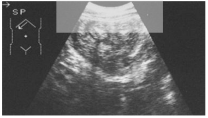 <p>The area in the near field close to the transducer having poor imaging due to artifact.</p>