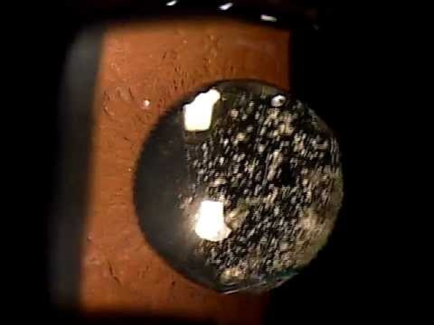<p>Spherical, white opacities that move with the vitreous</p>