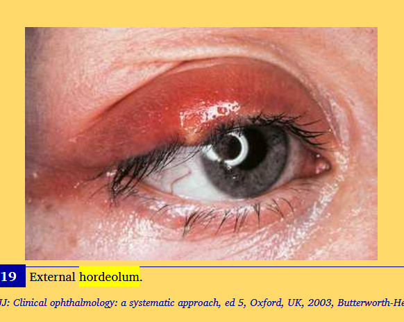 <p>hordeolum</p>