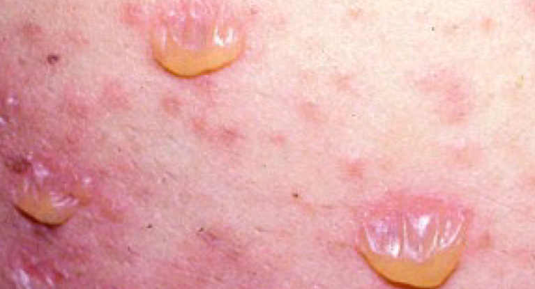 <p>what type of lesion is depicted and what condition</p>