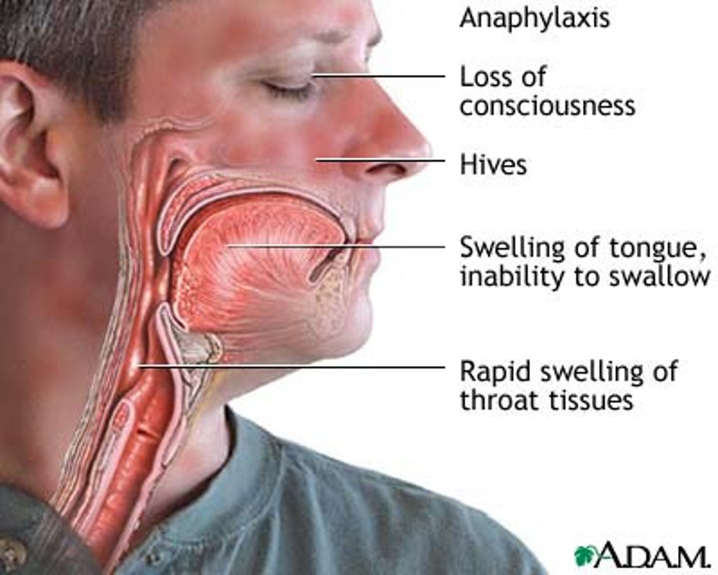 <p>1. Breathlessness<br>2. Wheeze <br>3. Rash <br>4. Swollen lips/tongue <br>5. Low BP <br>6. Chest tightness</p>