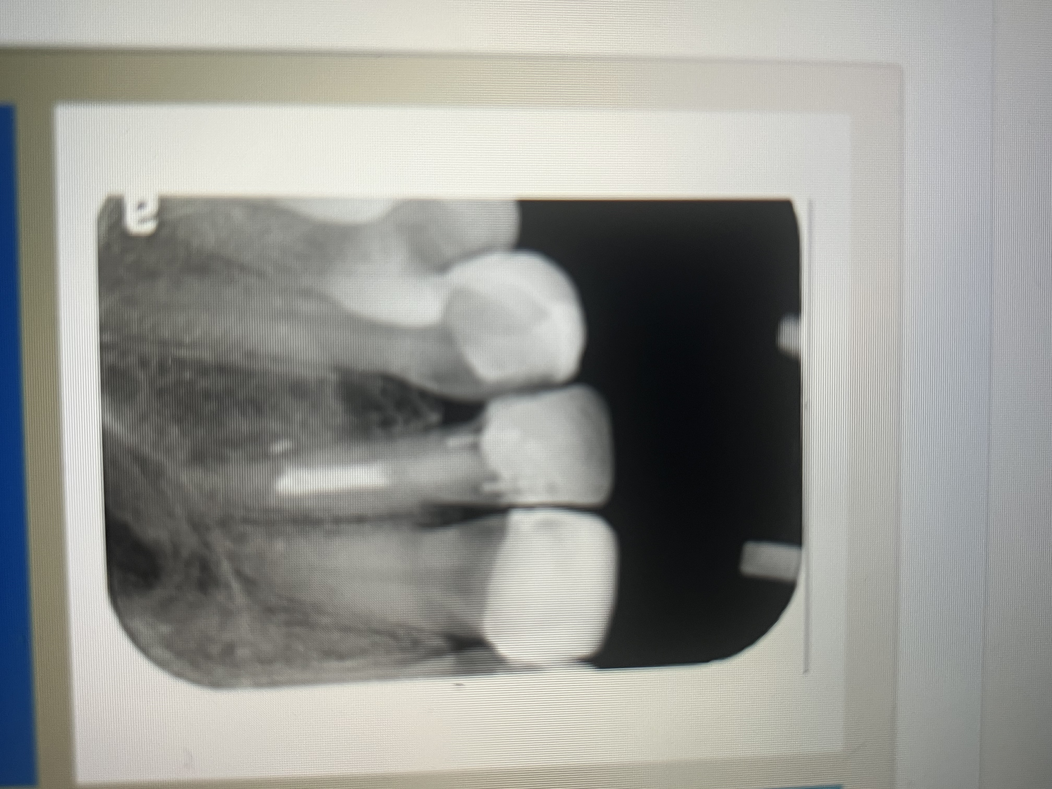<p>Varies from radiolucent to slightly radiopaque, depending on the composition. </p>