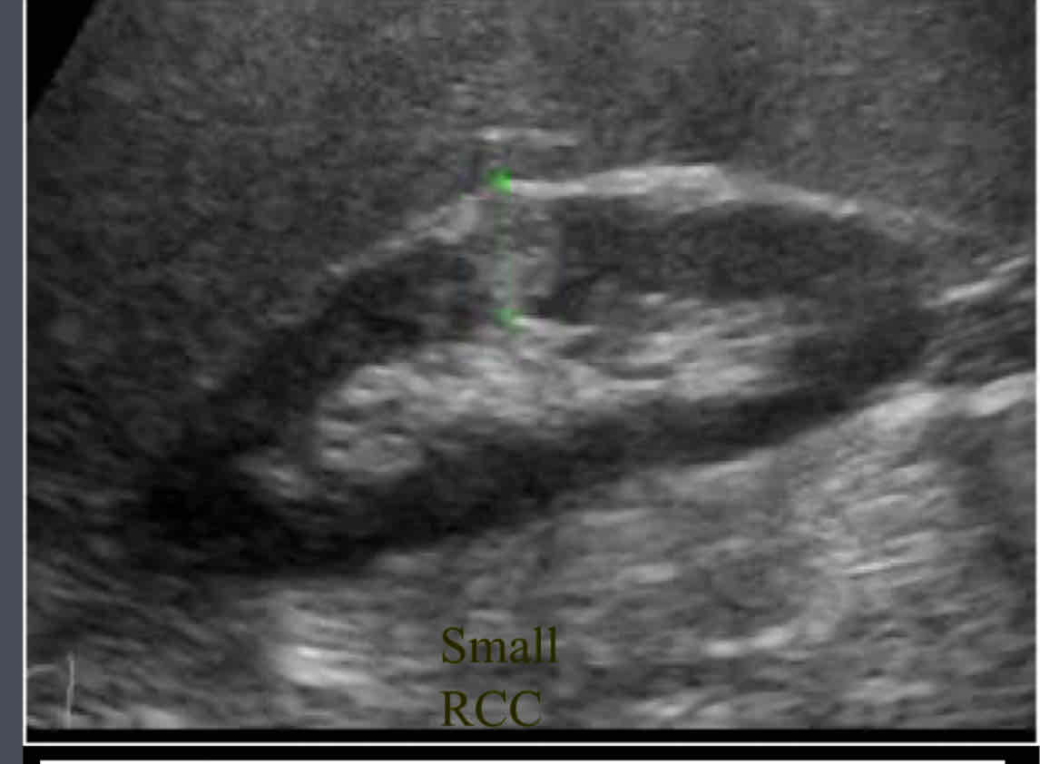 <p>In what does the patient may present with flank pain, hematuria (most common) and palpable mass?</p>