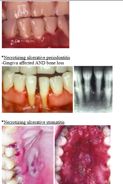 <p><span style="background-color: transparent; font-family: &quot;Times New Roman&quot;, serif;">*<u>Linear Gingival Erythema</u></span></p><p><span style="background-color: transparent; font-family: &quot;Times New Roman&quot;, serif;">-Etiology = <strong>candida</strong></span></p><p><span style="background-color: transparent; font-family: &quot;Times New Roman&quot;, serif;">-Can be confused with <strong>marginal gingivitis&nbsp;</strong></span></p><p><span style="background-color: transparent; font-family: &quot;Times New Roman&quot;, serif;">*<u>Necrotizing ulcerative gingivitis</u>&nbsp;</span></p><p><span style="background-color: transparent; font-family: &quot;Times New Roman&quot;, serif;">-Punched out gingival papillae</span></p><p><span style="background-color: transparent; font-family: &quot;Times New Roman&quot;, serif;">*<u>Necrotizing ulcerative periodontitis</u></span></p><p><span style="background-color: transparent; font-family: &quot;Times New Roman&quot;, serif;">-Gingiva affected AND bone loss</span><br><span style="background-color: transparent; font-family: &quot;Times New Roman&quot;, serif;">*<u>Necrotizing ulcerative stomatitis</u></span></p>