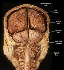 dural reflection that separates the cerebrum from the cerebellum and brainstem