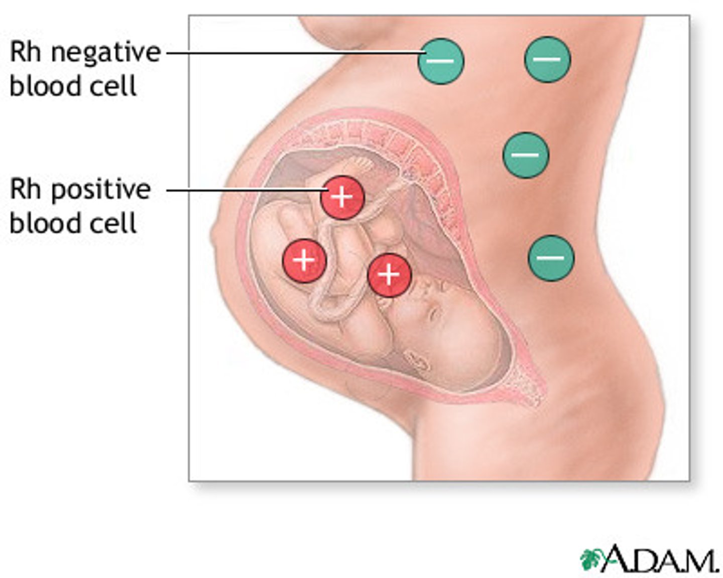 <p>The symbol indicating the lack of the protein Rh factor found in blood types (e.g., A-, B-, AB-, O-).</p>