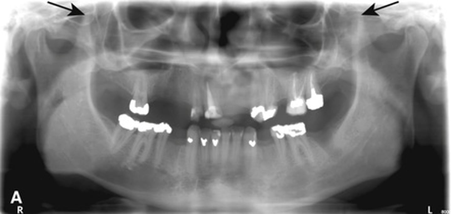 <p>What is this developmental abnormality, and what is the etiology for it?</p>