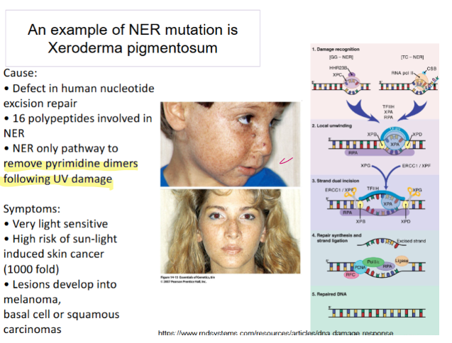 <p>xeroderma pigmentosum</p>