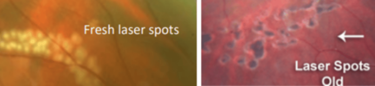 <p>prophylactic procedure where 3 rows of laser burns are used to create scarring that seals the retina down preventing a detachment. Patient may experience a small amount of pain. Scar will form in about 2 weeks.</p>