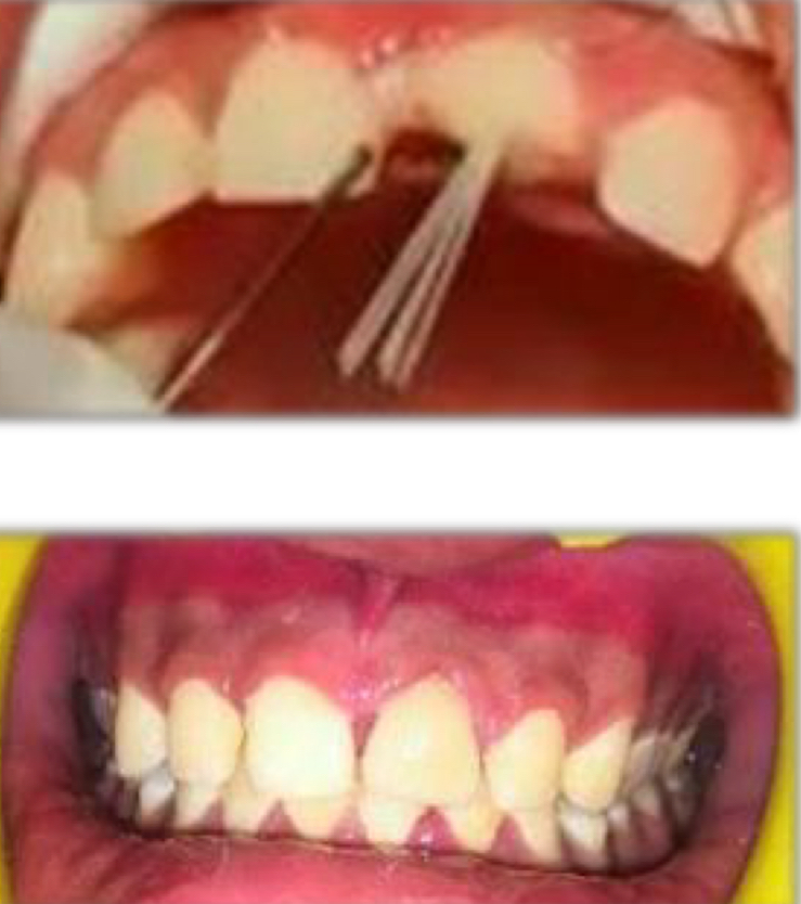 <p>Bundled glass fiber reinforced composite</p><p>Many fine individual posts 0.3mm diameter</p><p><strong>Remove sleeve</strong><span>- fibers </span><strong>spread </strong>inside the root canal<strong>, </strong>adapting to its exact shape- translucent so aesthetic </p>