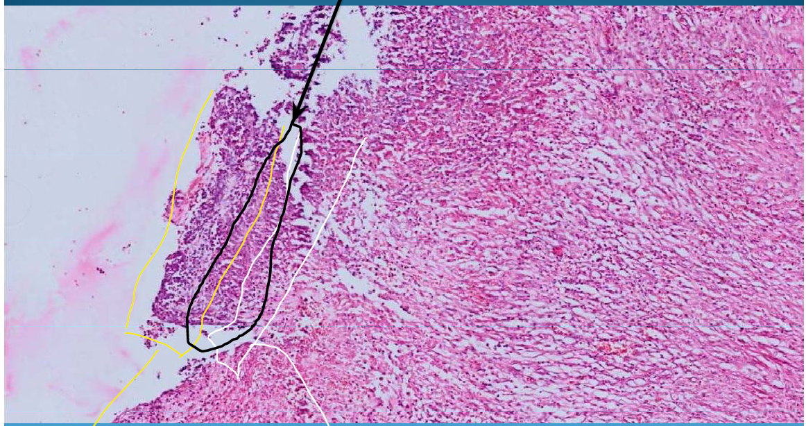 <p>Chronic gastric ulcer: lack of substance that will go under muscularis mucosa</p><p>Layers of Ulcer:</p><ul><li><p>1st layer - Fibrinoid necrosis</p></li><li><p>2nd layer - inflammatory cells</p></li><li><p>Granulomatous tissue layer between </p></li></ul>