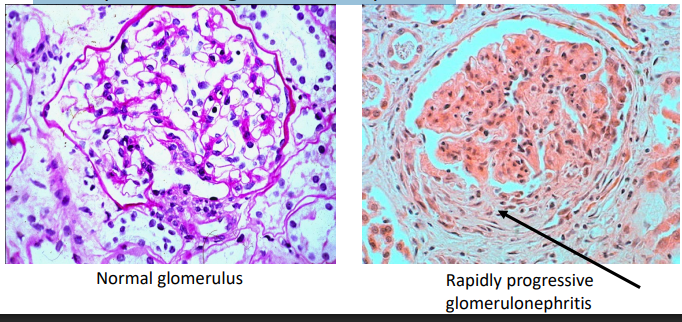 <p>Compare the glomeruli in these light microscopy images:</p><ul><li><p>Crescent made of proliferating epithelial cells </p></li><li><p>Compression of glomerular capillaries</p></li></ul><p></p>