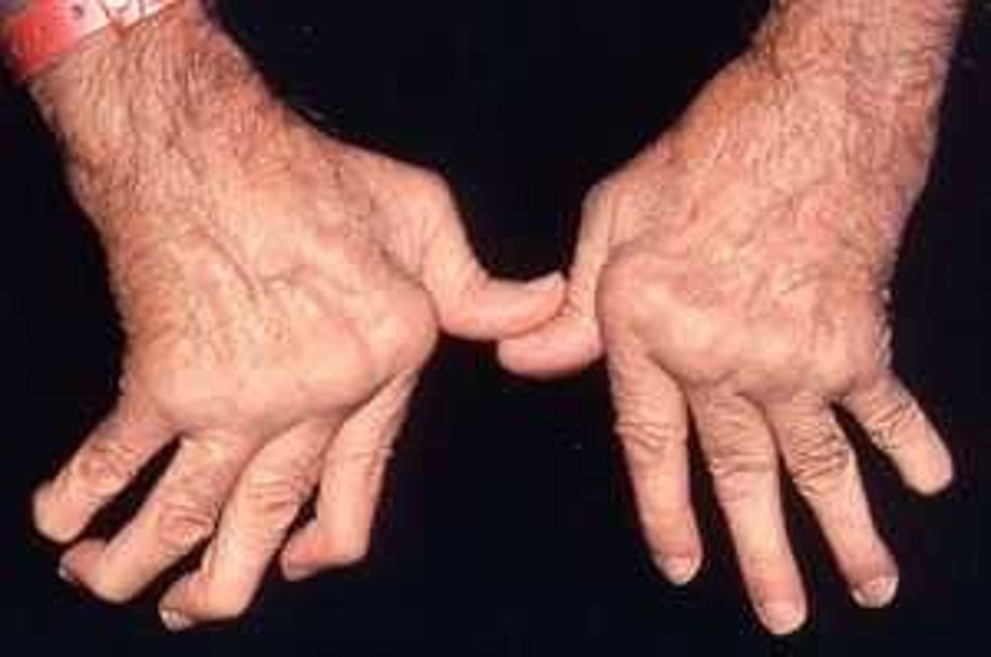 <p>Chronic inflammatory d/o w/ polyarticular, symmetrical joint involvement </p><p>+ Systemic symptoms </p><p>Swan neck and Boutonnière deformities </p><p>Rheumatoid nodules </p><p>Prolonged morning stiffness </p><p>Joints: soft tissue swelling in wrists, MCP, PIP </p><p>Fetty syndrome: triad of RA, splenomegaly, neutropenia </p>