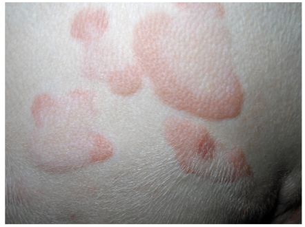 <p>elevated red spots filled with fluid; insect bites</p>