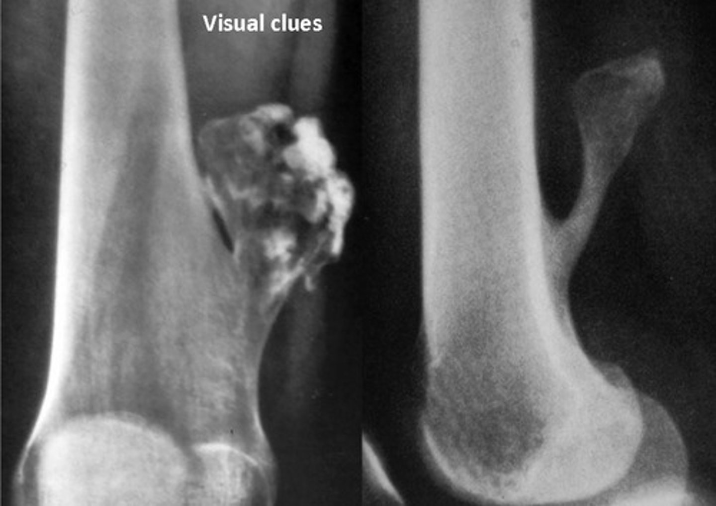 <p>Growths of abnormal cells which are contained in one area, usually within a membrane. They do not invade other parts of the body.</p>