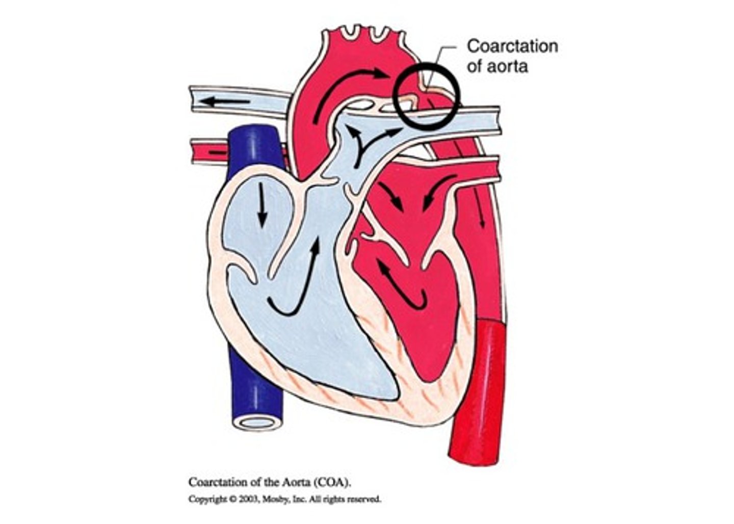 <p>Non-cyanotic congenital heart defect characterized by narrowing of the aortic arch usually in the proximal descending aorta; Turner syndrome (45, XO)</p>