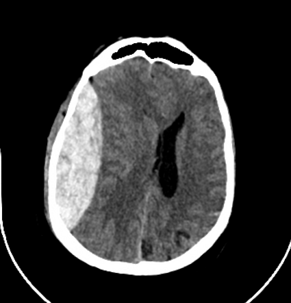 <p>-collection of blood between the skull and the outer layer of the dura </p><p>-often caused by disruption of the branch of the middle meningeal artery </p><p>s/s: </p><ul><li><p>transient LOC </p></li><li><p>recovery with lucid period</p></li><li><p>secondary onset of headache </p></li><li><p>decreasing LOC again </p></li><li><p>maybe fully unconscious or never unconscious </p></li><li><p>Peds: only warning may be bradycardia or early papilledema</p></li><li><p>dilation of ipsilateral pupil </p></li><li><p>Cheyne-stokes respirations </p></li><li><p>bradycardia </p></li><li><p>death </p></li></ul><p></p>