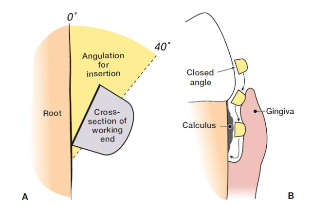 <p>0-40 deg → called a Closed Angle since the face is closed against the tooth </p>