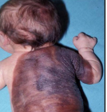 <p>a type of nevus present at birth, characterized by pigmented lesions that may vary in size and can carry a RISK of MELANOMA</p>