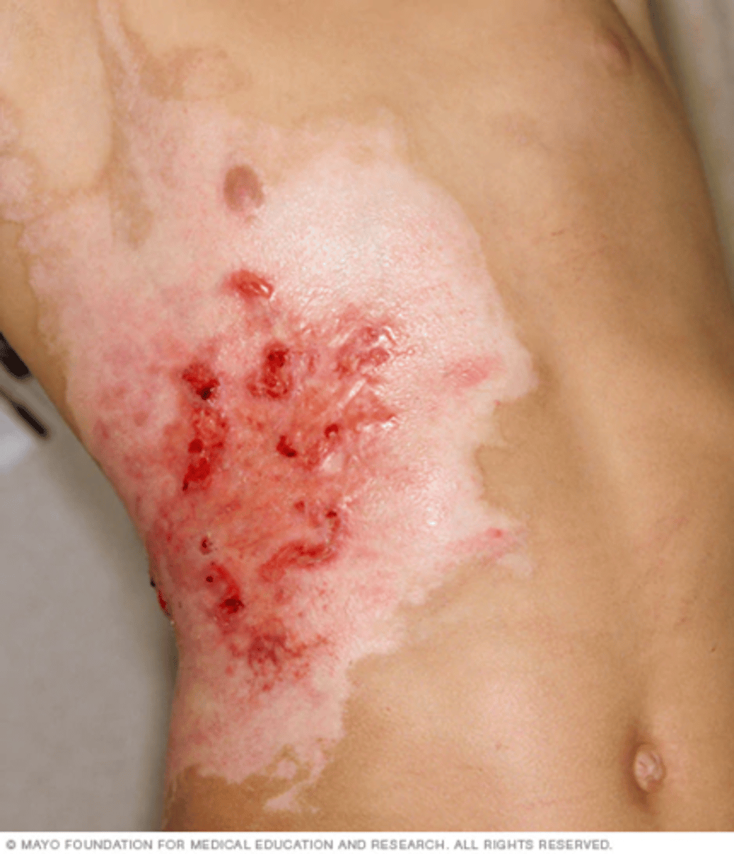 <p>Destroys entire thickness of the skin; Surface of wound is leathery and may be brown, tan, black, white, or red; Patient feels no initial pain</p>