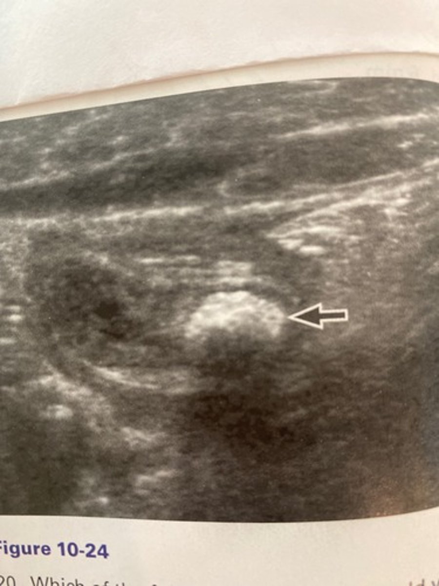 <p>What does the arrow demonstrate in the patien in Figure 10-24 who complained of focal right lower quadrant pain?</p><p>a. Appendicolith</p><p>b. Thyroid in the belly</p><p>c. Olive sign</p><p>d. McBurney sign</p>