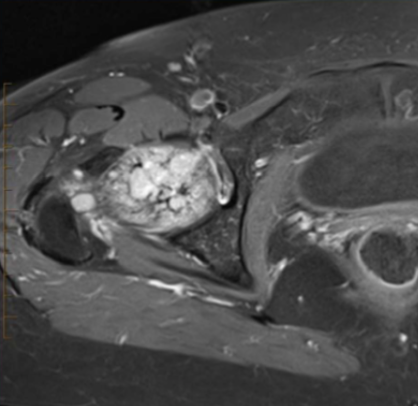 <p>Describe the pathology (hint: it’s bone) (Ax T1 FS +C). </p>