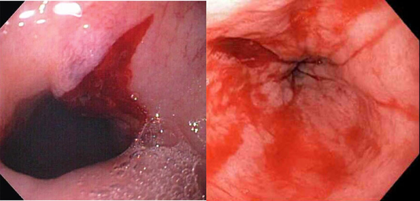 <p>longitudinal tear near gastroesophageal junction; not transmural but causes hematemesis </p><p>EGD indicated for dx and tx </p>