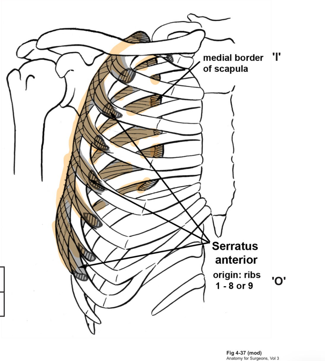 <p>O= ribs 1→8/9</p><p>I= medial border of scapula</p><p>A=protracts the scapula. Lower fibres help to superiorly rotate the scapula</p><p>IN=long thoracic nerve</p><p></p><p>CLINICAL RELEVANCE=wing scapula occurs when thoracic nerve is severed and therefore nerve supply to serratus anterior is compromised (normally holds the scapula against the thorax) </p>