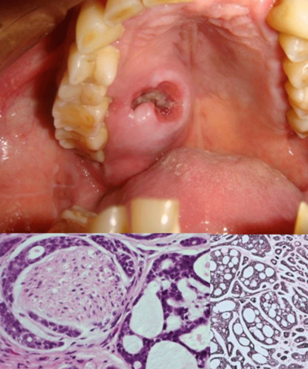 <p>CONSTANT PAIN</p><p>• firm, poorly-defined swelling</p><p>• histo: swiss cheese</p><p>• common location: palate</p><p>• population: females 50-60</p>