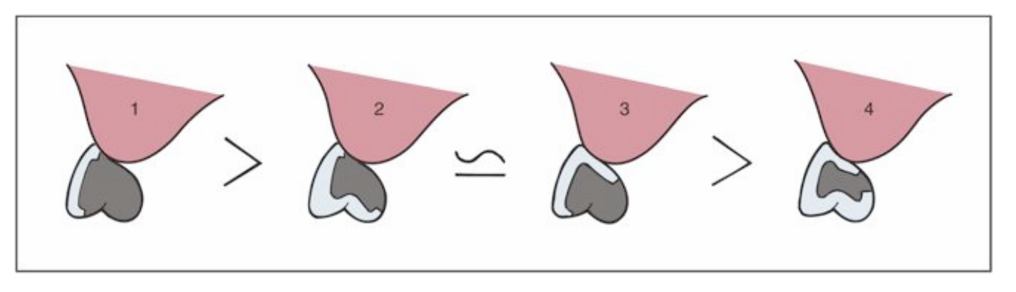 <p>when vertical space is minimal, which design may be contraindicated </p>