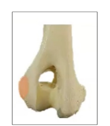 <p>• Lateral side of the humeral condyle</p><p>• Giving rise to the extensors of the forearm</p><p>• Extensor epicondyle</p>