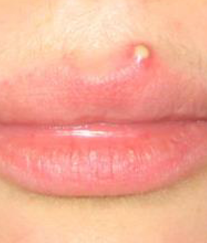 <p>Pustule&nbsp;</p>