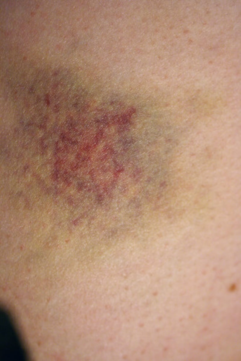 <p>Injury with no break in the skin characterized by pain swelling and discoloration also called bruise</p>