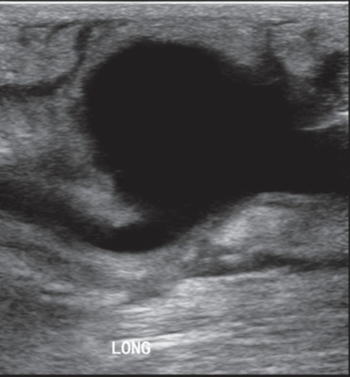 <p>Common in CFA grafts</p><p>Look for neck</p><p>To and fro flow</p>