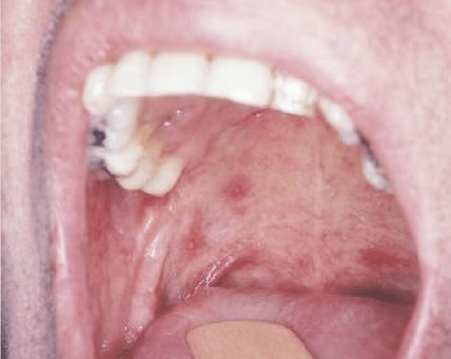 <p>multiple tiny ulcers</p><p>• common location: anywhere in oral cavity</p><p>• population: females</p>