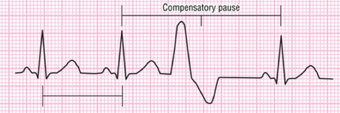 <p>Extra heartbeats that are out of the normal rhythm.</p>