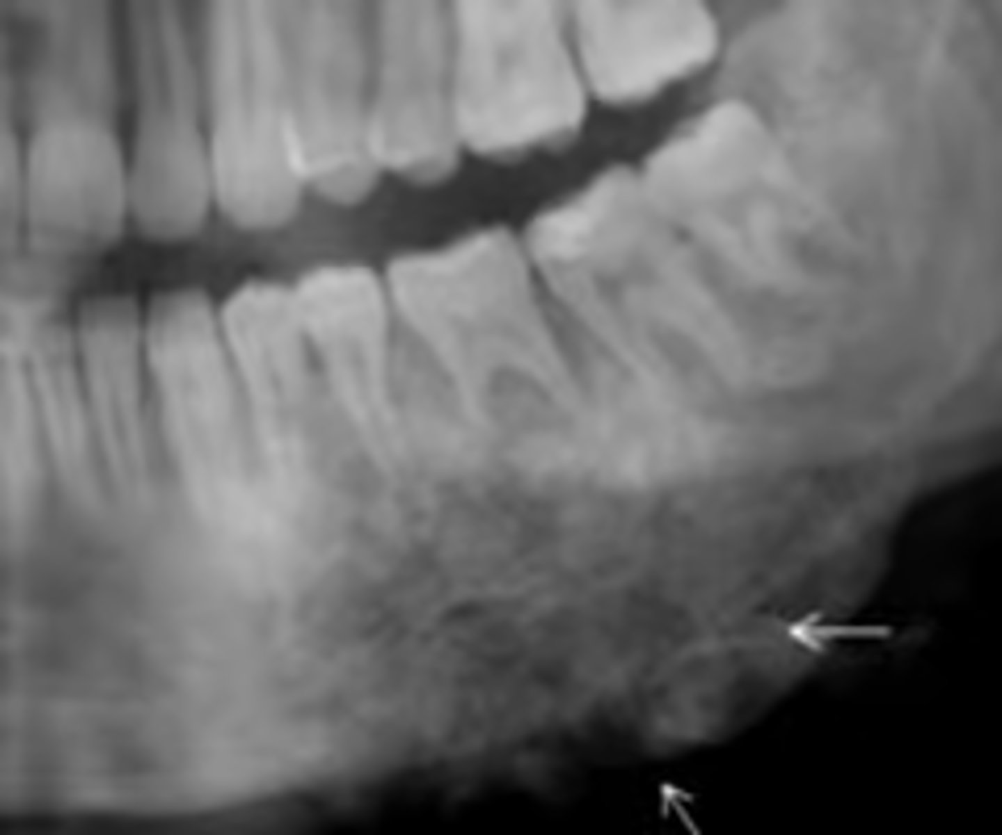<p>Patient's radiograph shows the following. What is the diagnosis?</p><p>- Garrington sign (widened PDL space)</p><p>- Ragged, ill-defined radiolucent/paque mixed area</p><p>- 'sun ray' periosteal reaction</p><p>- spiked root resorption pattern</p>