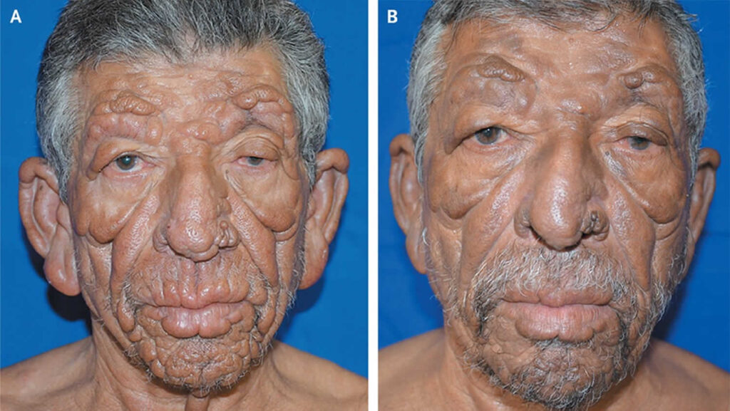 <p><strong>Multibacillary leprosy</strong> (tuberculoid form of leprosy)</p>