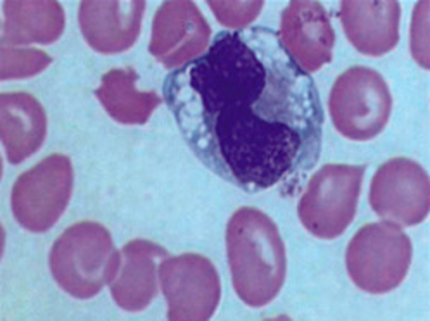 <p>Increased numbers of these may indicate a chronic condition or recovery phase of an acute condition</p>