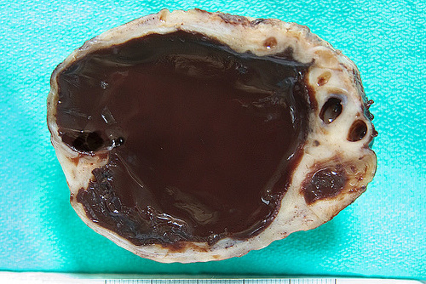 <p>endometriosis in ovary</p>