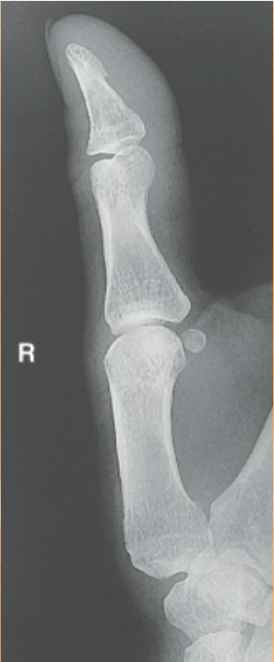 <p>-open joint space</p><p>-no foreshortening (digit is parallel to the IR)</p><p>-no rotation: concavity and equal amount of soft tissue </p>