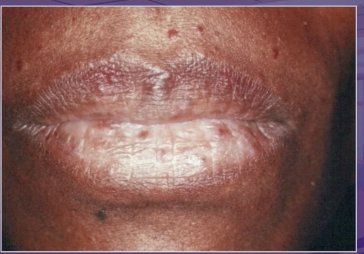 <p>what is the dx of these dilated blood vessels </p><p>ecchymosis </p><p>telangiectasia </p><p>petechia </p><p>hematoma </p>